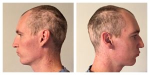 Thinning sides